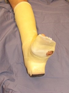 גבס פלסטי קל עם חור מתחת לפצע