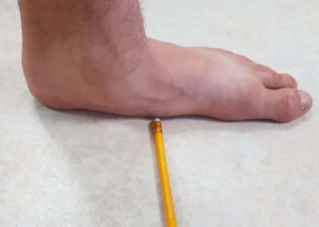 כף רגל שטוחה