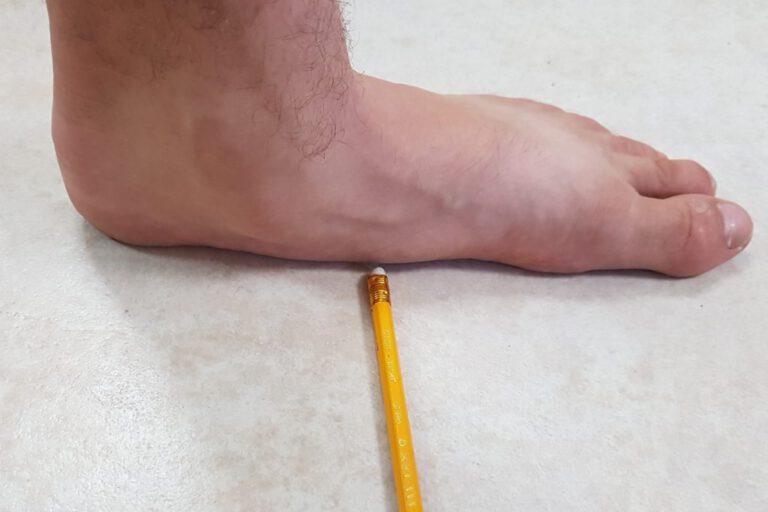 כף רגל שטוחה