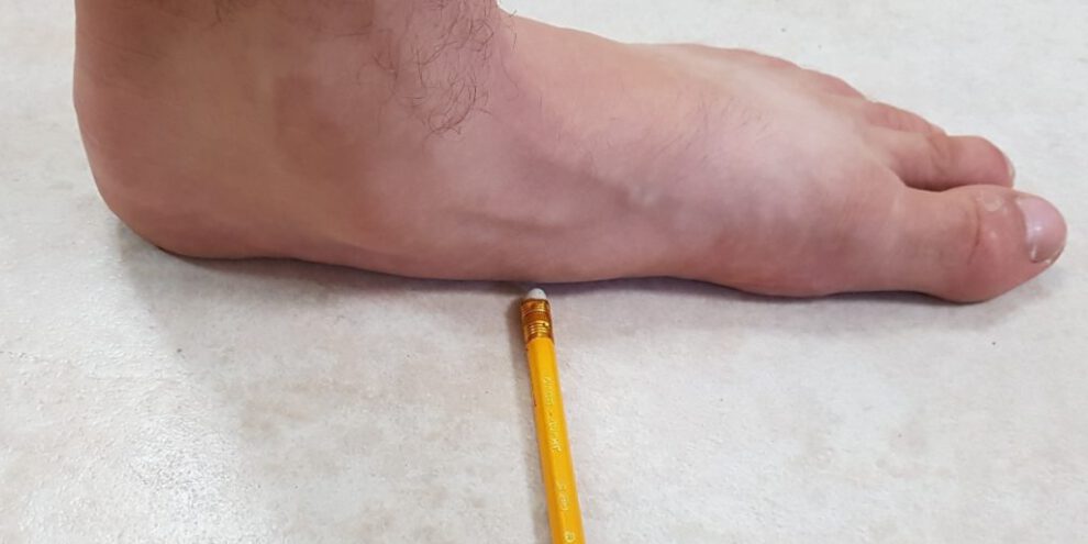 כף רגל שטוחה