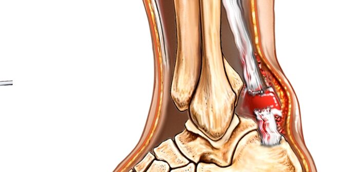 קרע גיד אכילס