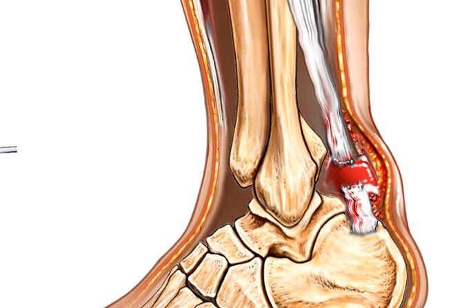 קרע גיד אכילס