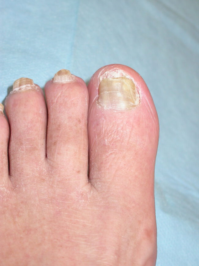 פטרת ציפורניים פטרת ציפורניים