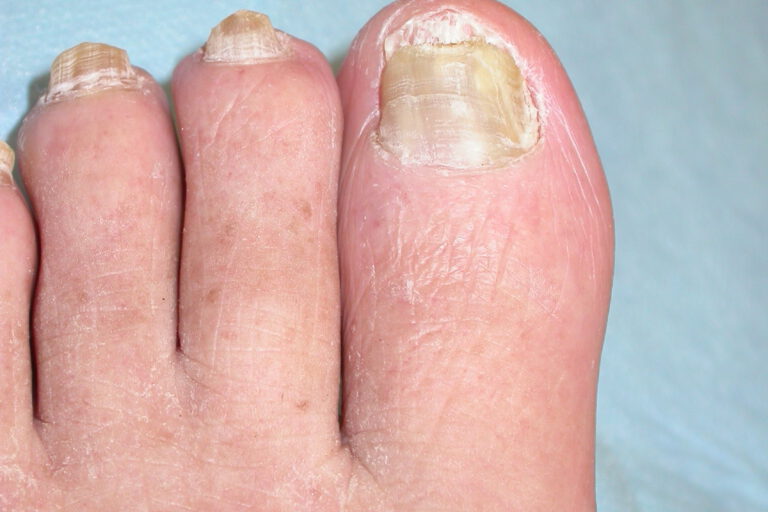 פטרת ציפורניים