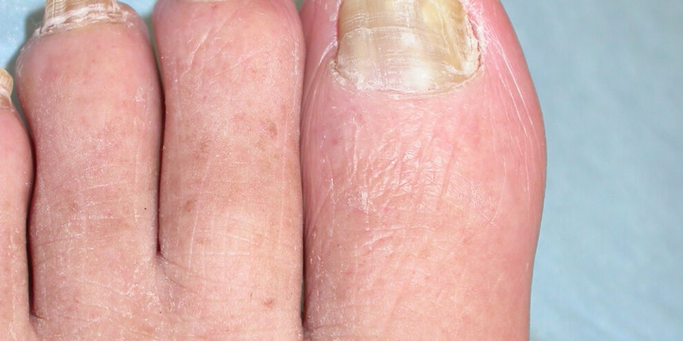 פטרת ציפורניים