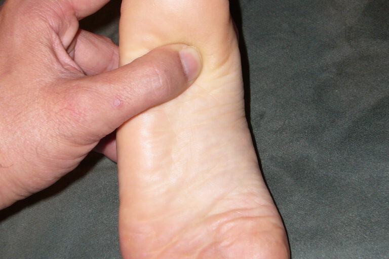 פלנטר פצאיטיס