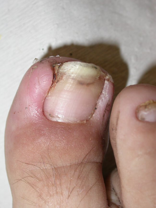 ציפורן חודרנית ציפורן חודרנית