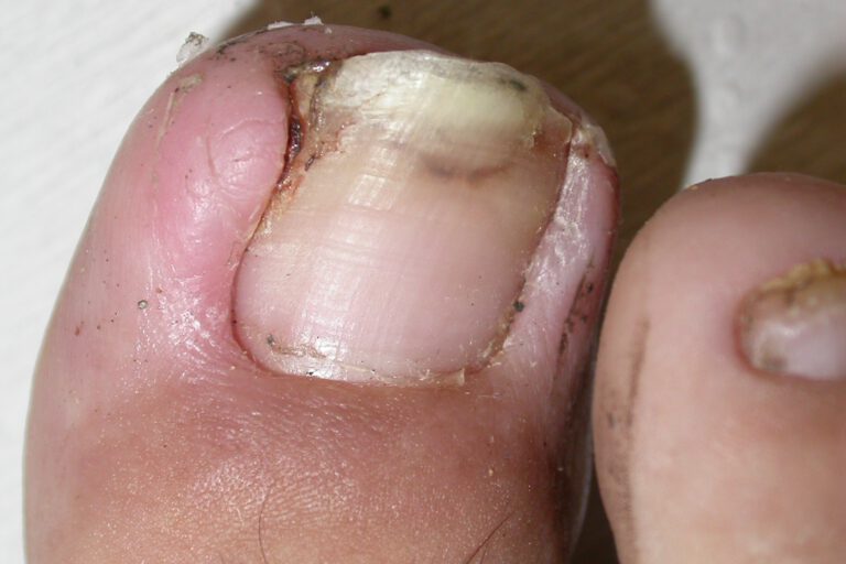 ציפורן חודרנית