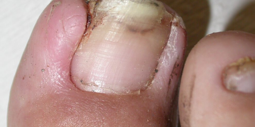 ציפורן חודרנית