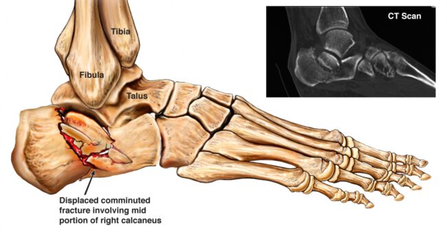 שבר בעקב שבר בעקב