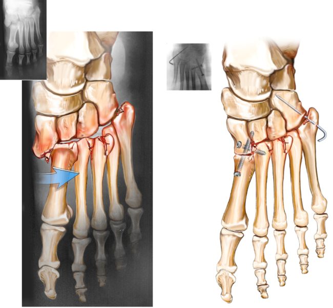 שבר פריקה מסוג ליספרנק