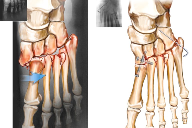 שבר פריקה מסוג ליספרנק