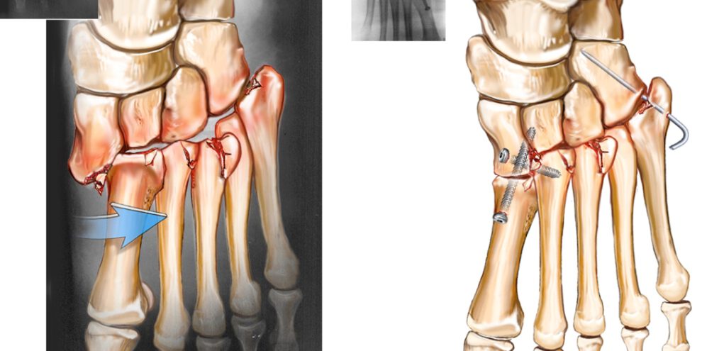 שבר פריקה מסוג ליספרנק