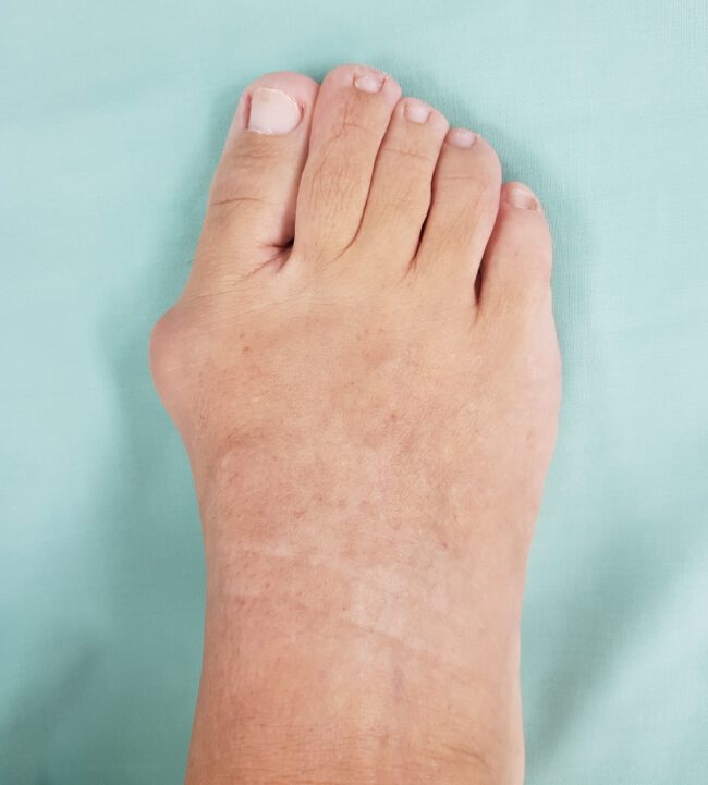 הלוקס ולגוס לפני ניתוח