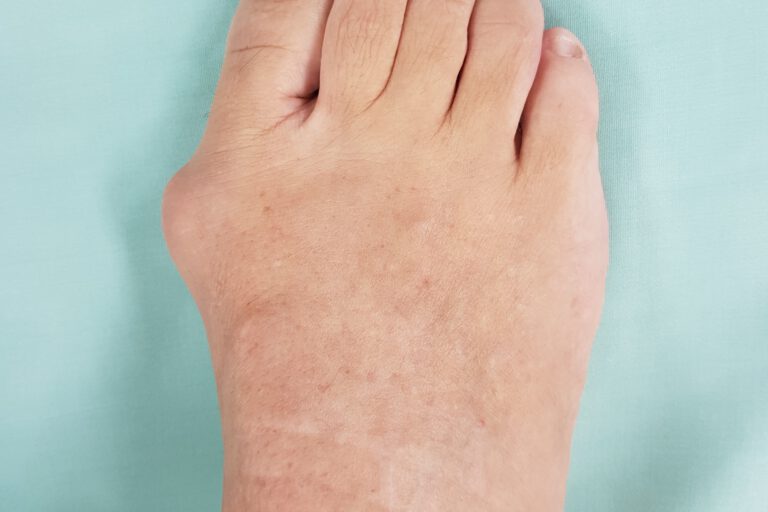 הלוקס ולגוס לפני ניתוח