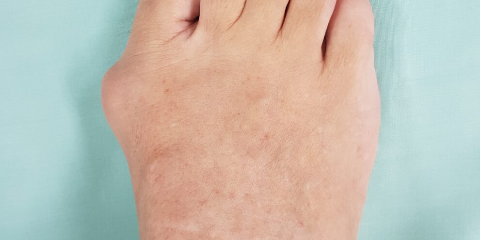 הלוקס ולגוס לפני ניתוח